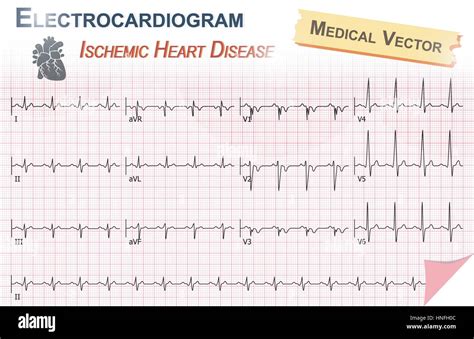 ecegj|Cardiovascular .